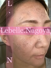 リベル 名古屋(Lebelle:)/ハーブピーリングリベル名古屋