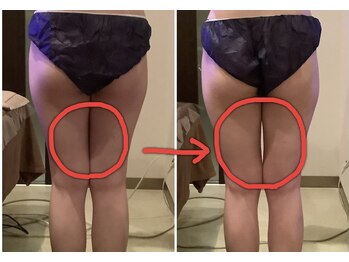 クレアボディ(CREA BODY)/内もも