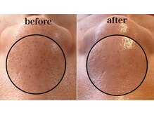 毛穴専科/ワックス脱毛メンズok/沖縄/那覇