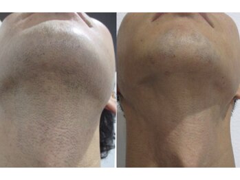 ダイアナ 出雲店(Daiana)/のどぼとけ　剃りにくくない？