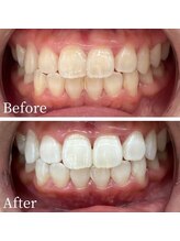 ウルル(Ululu)/ホワイトニング