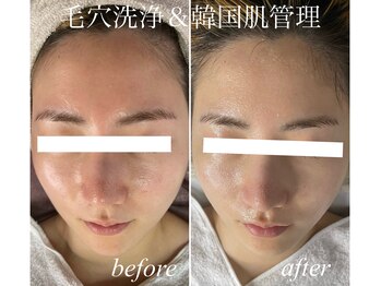 レイ(Rey)/毛穴エクストラクション　大人気