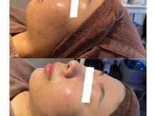 エイプリル/REVIVEハーブピーリング比較写真