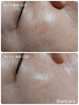 ビアンカーラ(Biancara)/浮き出る【韓国式3D毛穴洗浄】