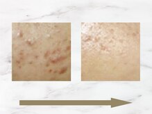 ハリロイヤル トーキョー武蔵小山/肌質改善で未来を変える。