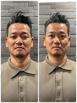 長寿鍼灸院 長寿整骨院/men's美容鍼50本効果★