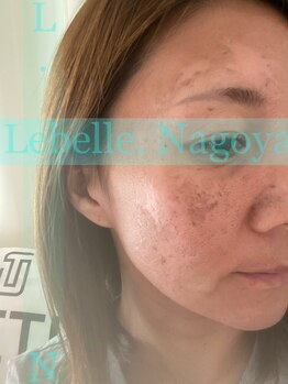 リベル 名古屋(Lebelle:)/ハーブピーリング専門名古屋