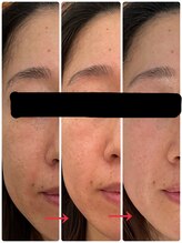 悠羽(yuuwa)/ヒト幹細胞美容液導入2回