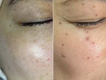 しらゆき 名古屋黒川/ターンオーバーと共にポロっと