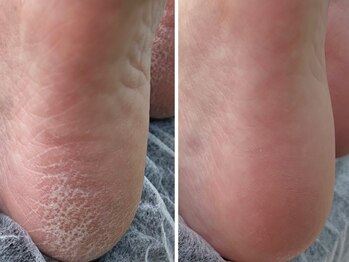 ケアプラス(care plus)の写真/【倉敷/中庄】巻き爪/フットケア専門店でしっとりふわふわな足裏やツルスベかかとを実現！理想の足元に♪
