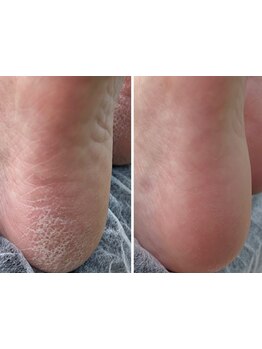 角質ケアができるサロン