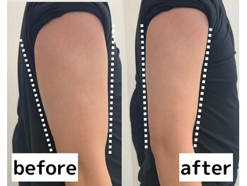 小顔専門店Lift(リフト)新宿西口/小顔専門店Lift|Before After