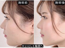アオヤマ サロン ワイゼット(AOYAMA SALON YZ)の雰囲気（左右差・輪郭悩みに人気の神小顔美容鍼）