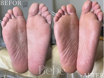 ベベ(Bebe)の写真/【韓国式美容で新感覚の角質ケア◎】角質が溜まりやすい男性のガサガサ足裏も徹底ケア☆[札幌/大通]