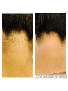 メープルサロン(MAPLE SALON)/うなじシュガーリング