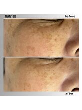 アガットバイミヤモト(agate by miyamoto)/イラストリアス(美白)1回施術