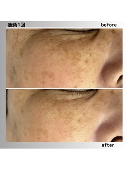 アガットバイミヤモト(agate by miyamoto)/イラストリアス(美白)1回施術