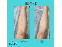 アクト クロ(ACT curro)/【脚全体】脱毛施術例