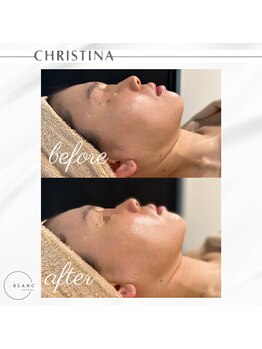 サロン ド ブラン アオヤマ(Salon de BLANC AOYAMA)/剥けないハーブピーリング