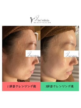 リノレリチア 心斎橋 新町店/KMPハーブピーリング