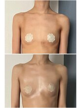 モア(moa)/全身バスト3回目