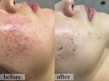 エステサロン ジョアアンジェ(joie ange)/ビオフィート 3回