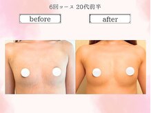 リール 恵比寿店(RIRE)/バストアップ症例【広尾恵比寿】