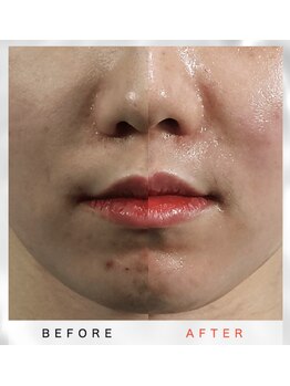 ホワイトアクア 福岡天神店(WHITE AQUA)/韓国の女医が開発したララピール