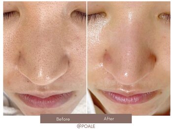 ポアレ 熊谷店(POALE)/毛穴ケア症例【埼玉/熊谷】