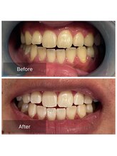 脱毛サロン メンズ 堂々/ホワイトニング