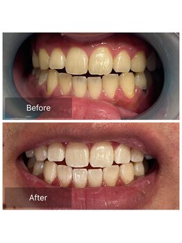 脱毛サロン メンズ 堂々/ホワイトニング