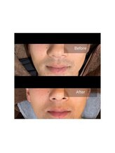 ルセヴィア(LUCEVIA)/メンズ脱毛/ひげ脱毛