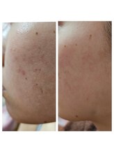 エターナル(Eternal)/知らない間にザラつきが増した肌