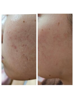 エターナル(Eternal)/知らない間にザラつきが増した肌