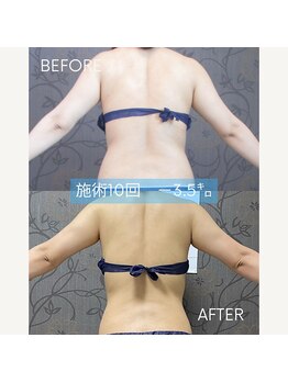 ヴィオテラス(VIOTERACE)/☆背中引き締め★