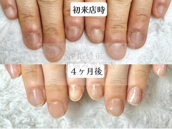 深爪矯正 爪悩み専門店 cocomo/(深爪/長さだし/フィルイン)