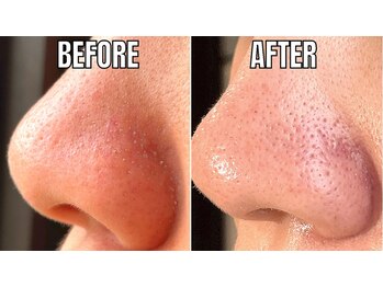 プレジール(Plaisir)/ハイドロフェイシャル☆