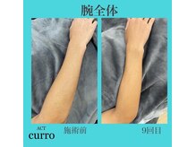 アクト クロ(ACT curro)/【腕全体】脱毛施術例