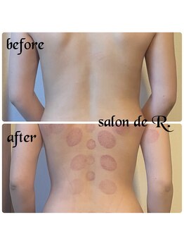 サロン ド アール(salon de R.)/【お背中骨氣20代・施術効果】