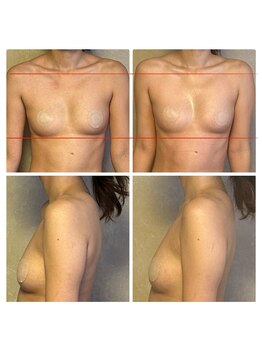 りんと/バストアップ