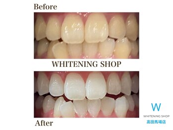ホワイトニングショップ 高田馬場店/ホワイトニングビフォーアフター