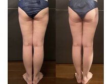 フェリシア(FELICIA)/脂肪冷却当日ビフォーアフター