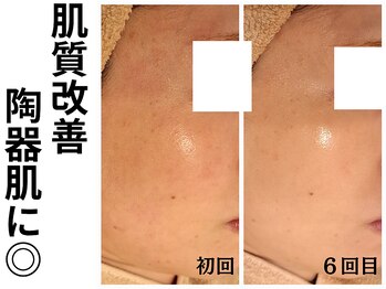 エリン(ERIN)/毛穴徹底洗浄×美容液導入