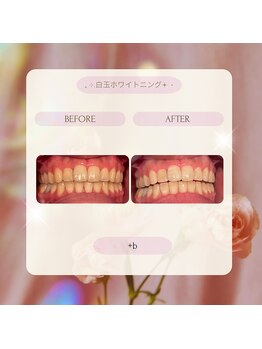 プラスビー 2号店(+b)/ホワイトニングビフォーアフター
