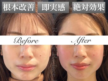 リフェイス(Re:face)