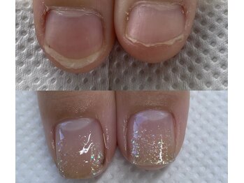 むしり爪を改善し美爪へ