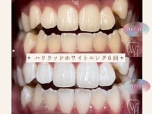 ビーモア(be more)/ホワイトニングBefore After