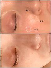 リリ(Ririi)/光フェイシャルで肌美人♪