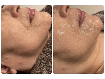 サロンドフェイス 木曽川店(Salon de Faith)/ほうれい線・たるみケア☆