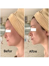 スペチアーレ 夙川/驚きの引き上がりで横顔も美しく